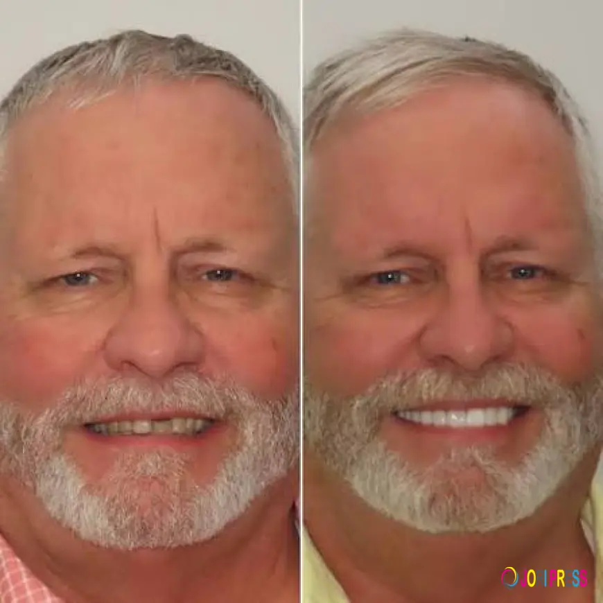 How Can Class 1 Veneers Restorations Support Non-Surgical Chin Enhancement?