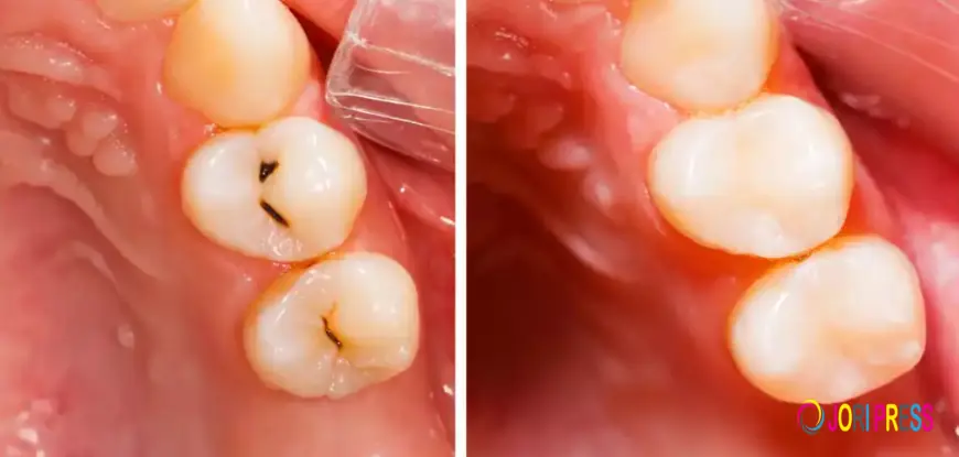Sensitive Teeth After Filling? Causes, Relief & When to Worry