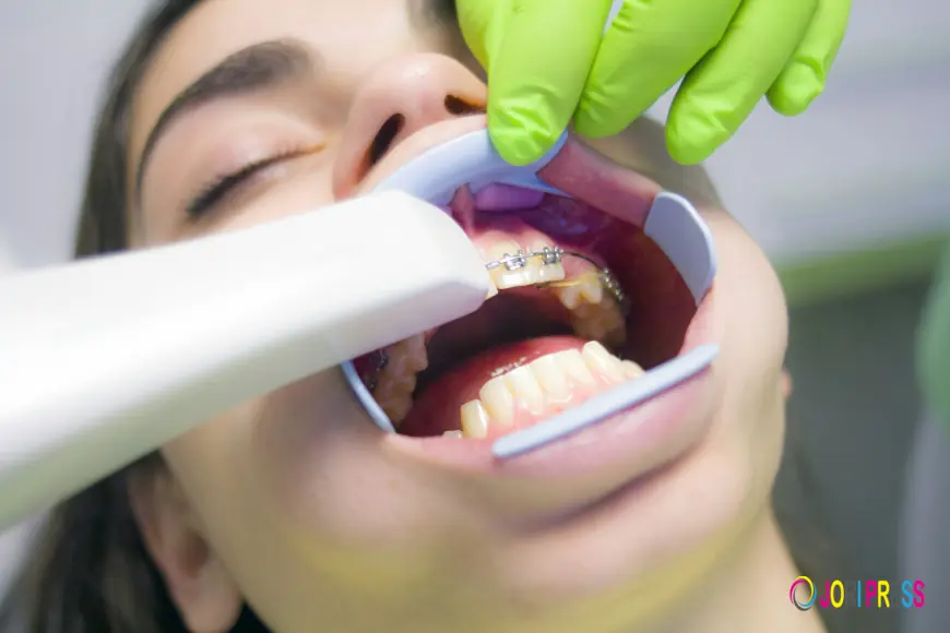 Maple Lake Braces: What Should You Know Before Choosing Braces?