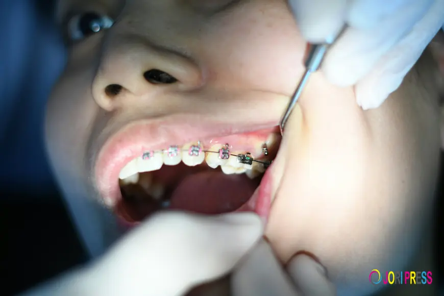 Cokato Braces: What to Know Before Starting Orthodontic Treatment