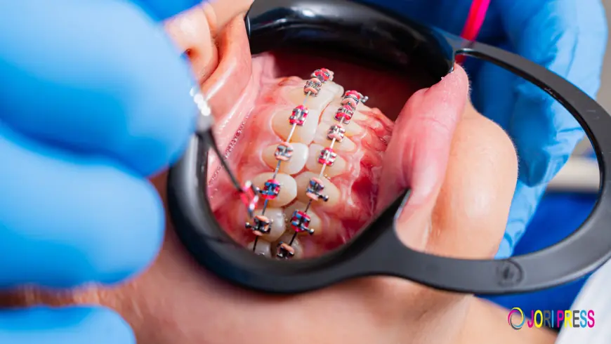 Monticello Braces: What Should You Know Before Starting Treatment?