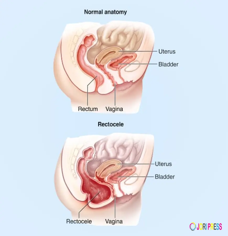 Ayurvedic Care for Prolapsed Rectum