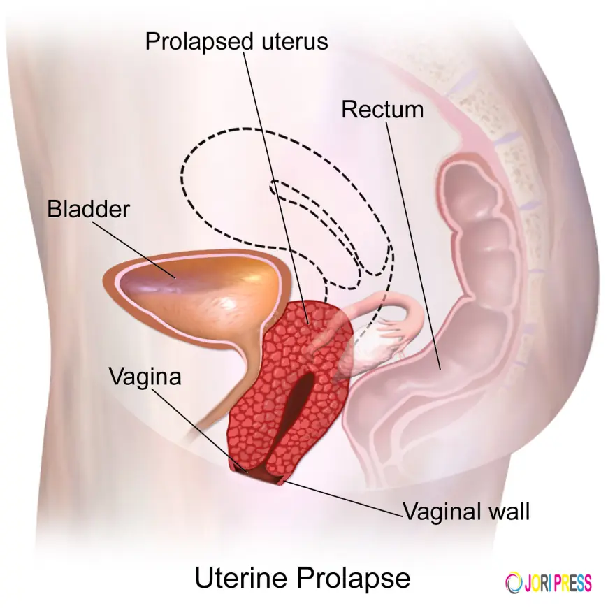 Ayurvedic Care for Prolapsed Uterus
