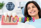 Replacing a Front Tooth With a Dental Implant