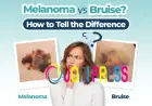 Nail Bruise or Subungual Melanoma? Key Differences