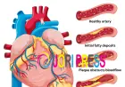 Angioplasty in Heart: The Recovery Questions Patients Are Afraid to Ask