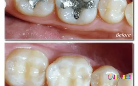 Tooth-Colored Fillings vs Silver Fillings: Which Is Better?