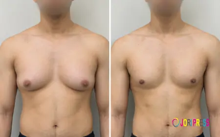 Gynecomastia: Causes, Treatment Options, and Male Breast Reduction Surgery