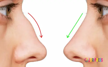 Nose Thread Lift in Singapore: A Non-Surgical Way to Reshape Your Nose