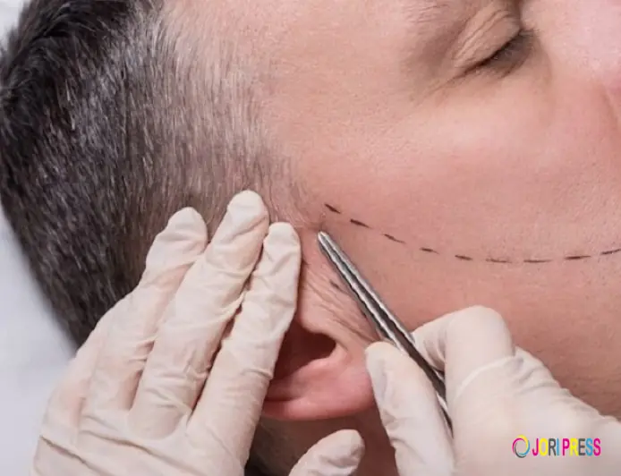 Want Hair Ltd Cements Its Position as a Leading Beard Transplant UK Provider