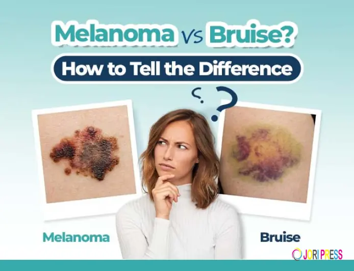 Nail Bruise or Subungual Melanoma? Key Differences