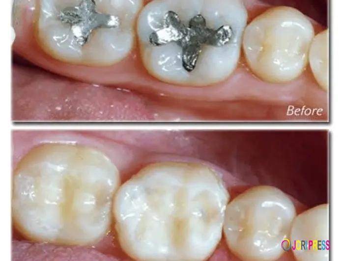 Tooth-Colored Fillings vs Silver Fillings: Which Is Better?