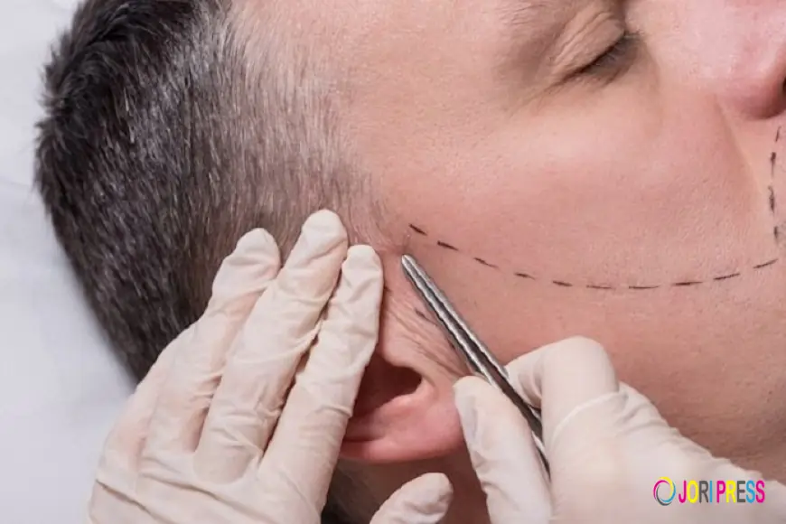 Want Hair Ltd Cements Its Position as a Leading Beard Transplant UK Provider
