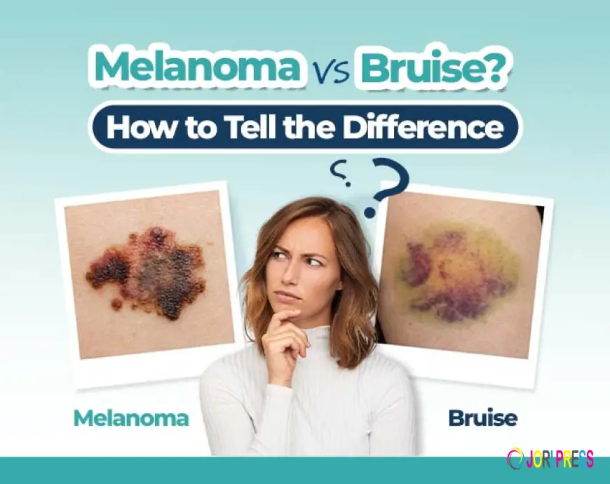 Nail Bruise or Subungual Melanoma? Key Differences
