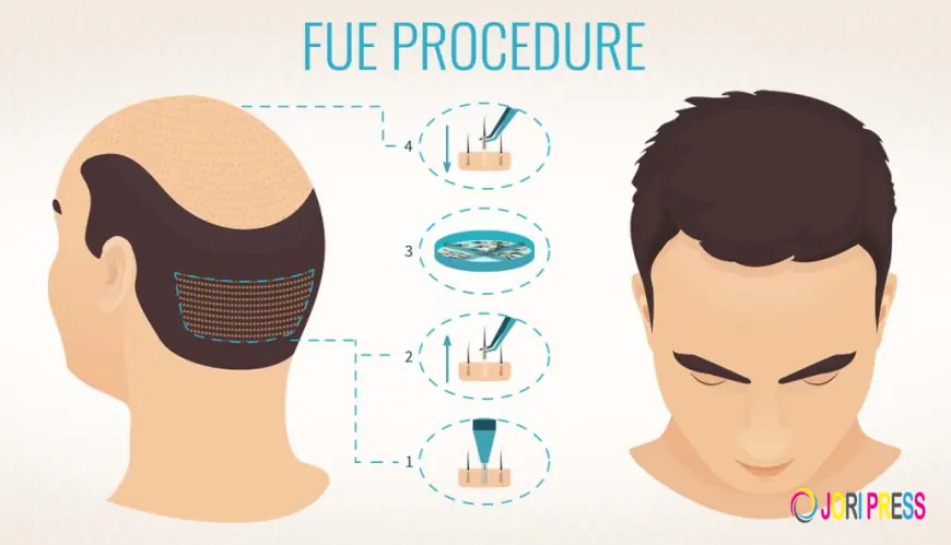 Want Hair Ltd Welcomes New Specialist Team to Lead FUE Hair Replacement Treatments