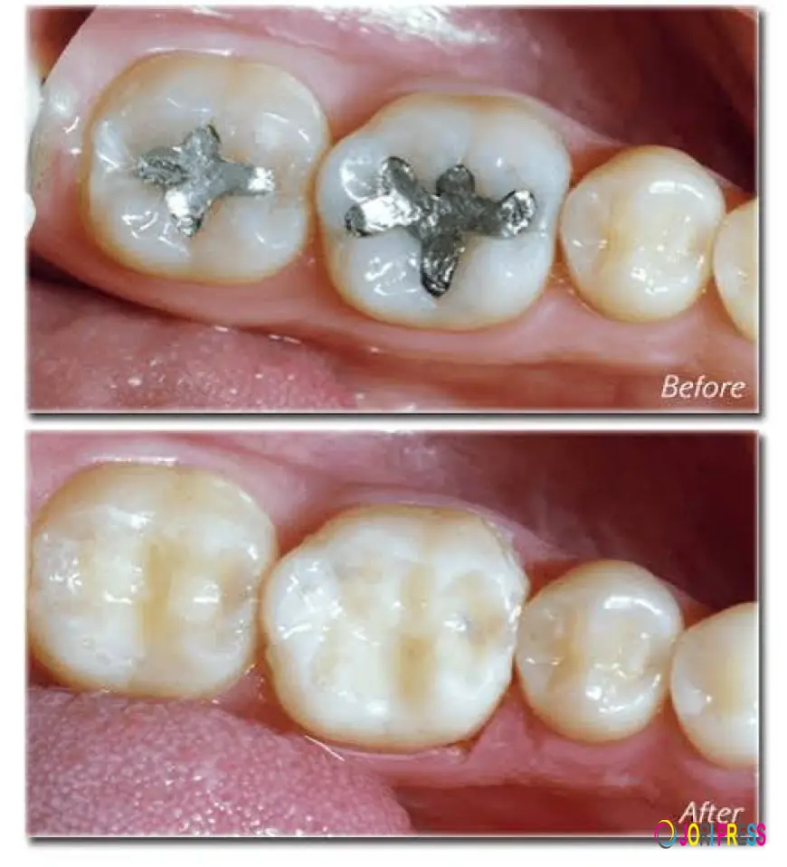 Tooth-Colored Fillings vs Silver Fillings: Which Is Better?