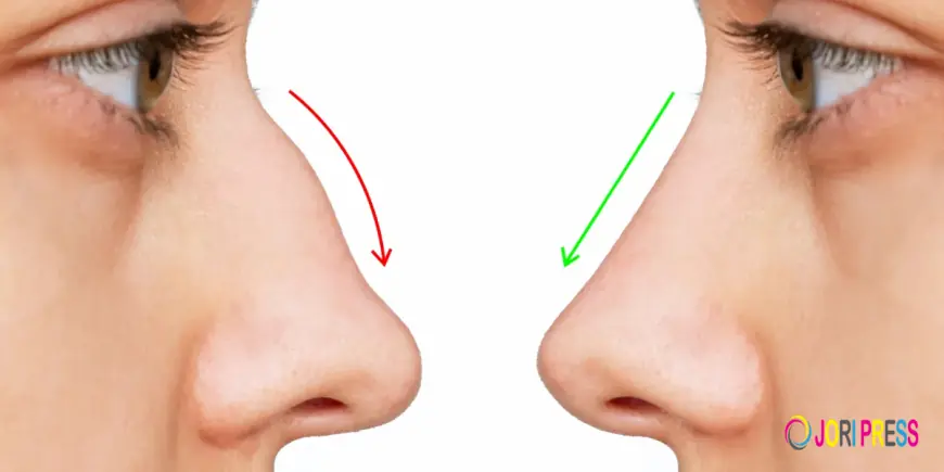 Nose Thread Lift in Singapore: A Non-Surgical Way to Reshape Your Nose